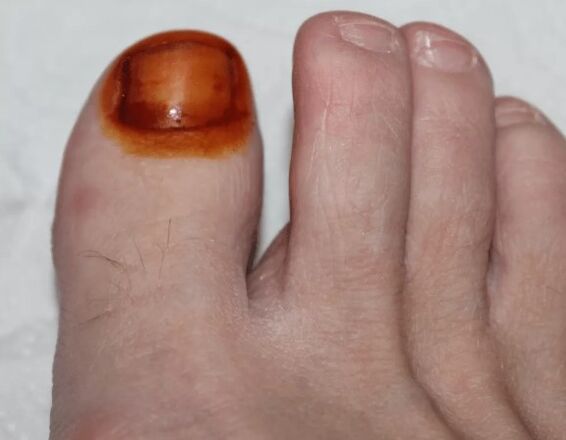 Tratamentul ciupercii iodului