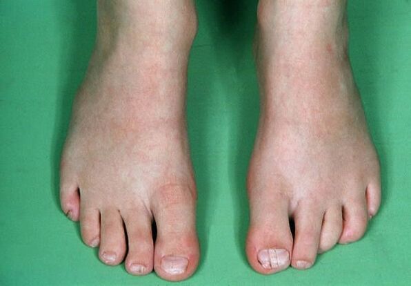 Ciuperca de pe picioare