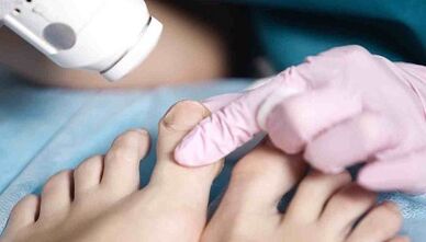 Tratamentul hardware al ciupercii pe picioare