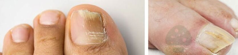 Ciuperca de unghii a degetului mare de pe picior