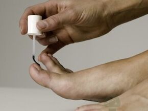 Tratamentul ciupercii de unghii