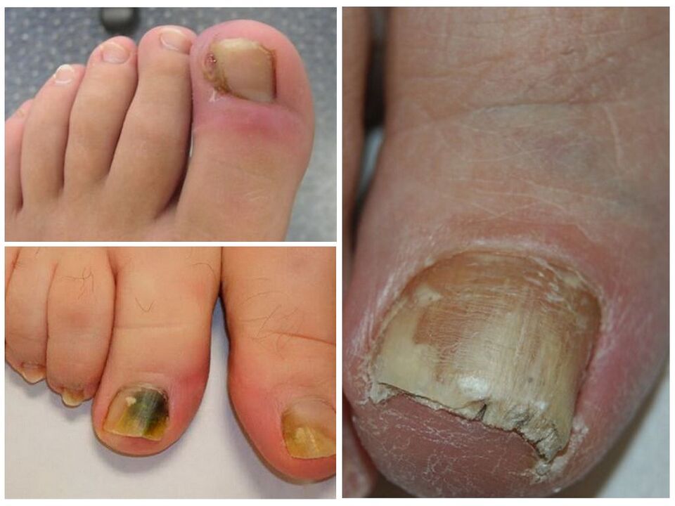 infecție fungică a unghiilor de la picioare