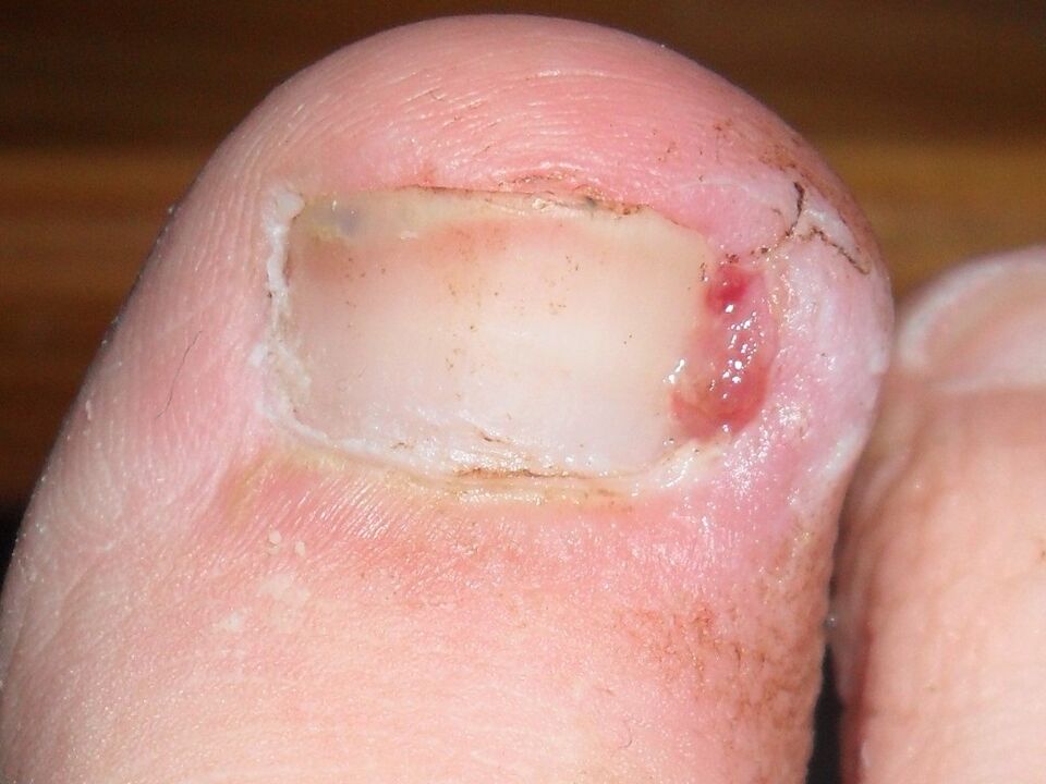unghia încarnată ca simptom al unei infecții fungice
