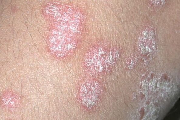 Psoriazisul cauzat de o infecție fungică