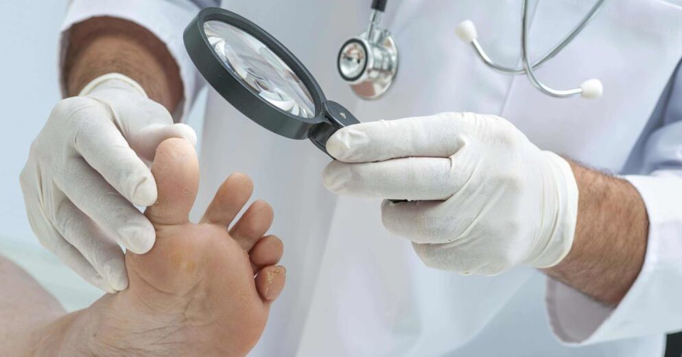 medicul examinează picioarele pentru ciupercă